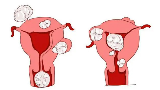 子宫肌瘤容易引起的并发症