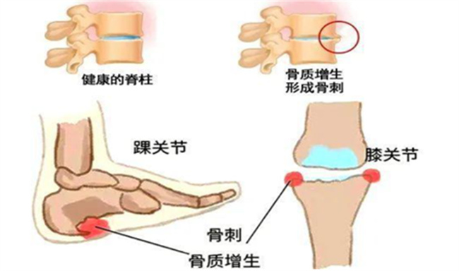什么是骨质增生