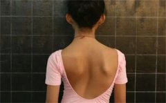 如何治疗脊柱侧弯