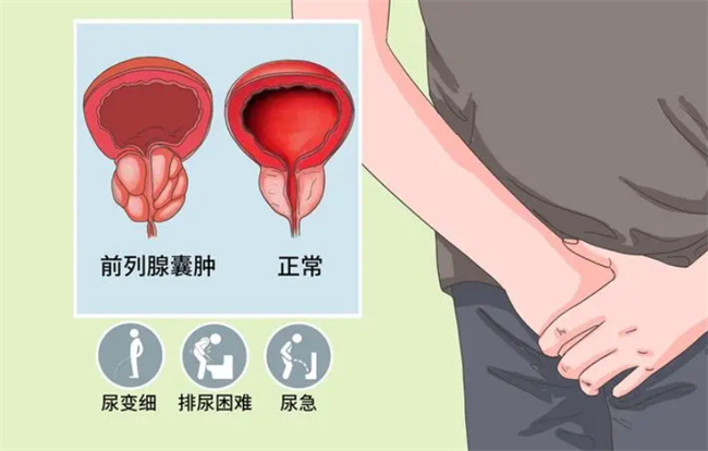   女性尿道旁囊肿的原因和护理方法