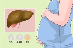 妊娠急性脂肪肝可以预防吗