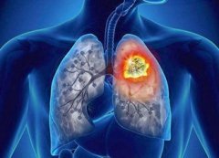 肺癌有哪些症状 会传染吗