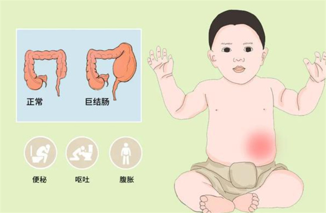 胎儿先天性巨结肠有什么症状