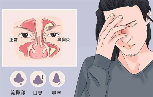 鼻炎会引起鼻咽癌吗