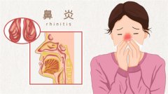 鼻炎会引起鼻咽癌吗
