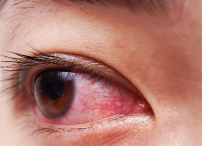 怎样预防眼睛红血丝