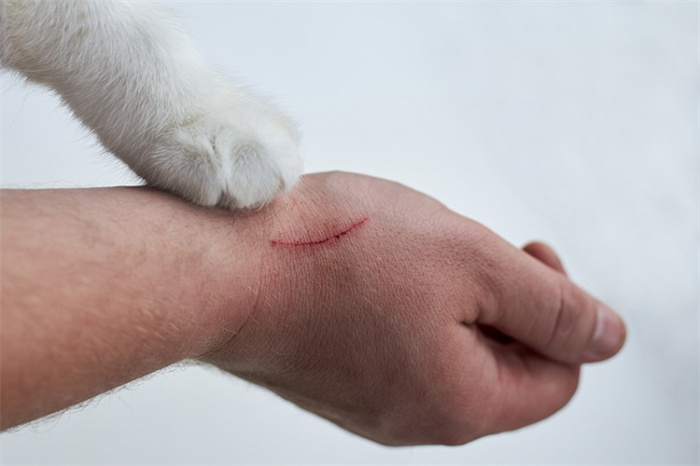 如何治疗猫抓病