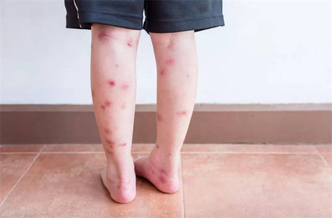 常见驱蚊剂的危害有哪些