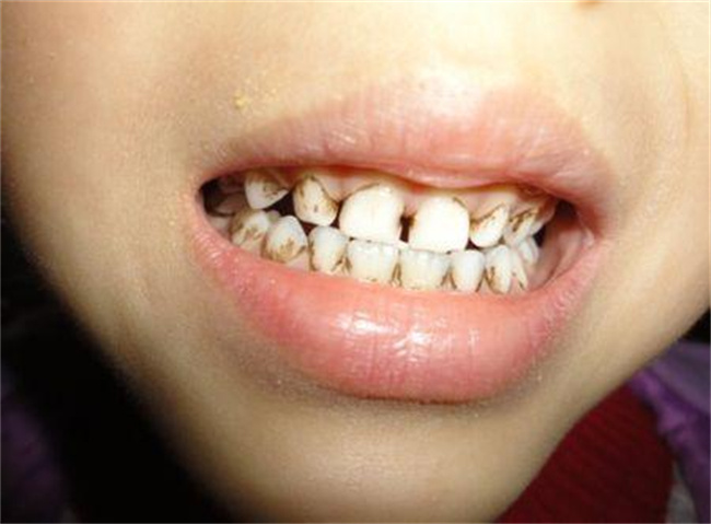 宝宝口腔卫生：如何有效去除牙菌斑