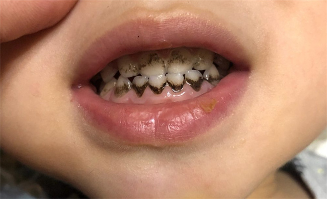 宝宝口腔卫生：如何有效去除牙菌斑