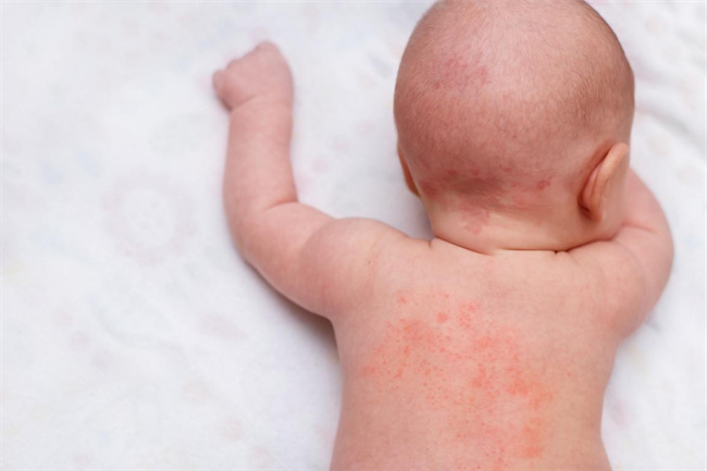 宝宝对青霉素过敏有哪些症状