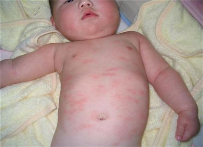 宝宝对青霉素过敏有哪些症状