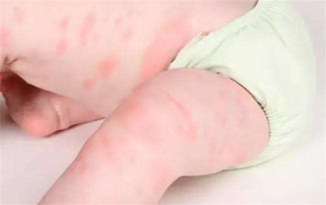 宝宝螨虫过敏的症状有哪些？
