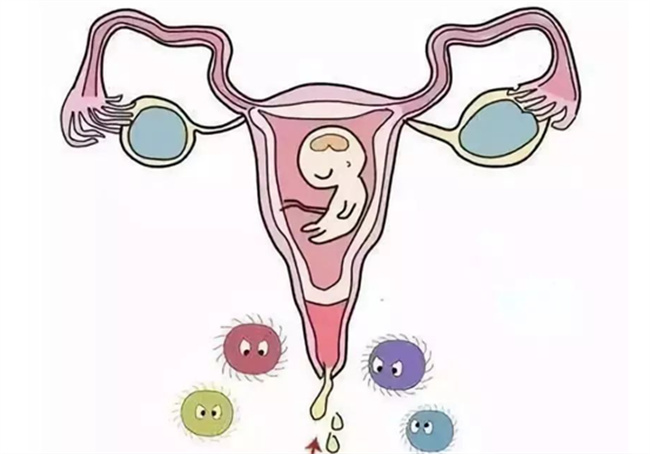 怀孕中期阴道炎预防措施：保持个人卫生，避免过度劳累