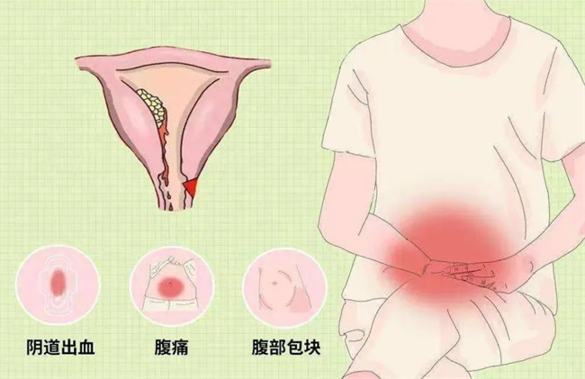 子宫肉瘤与子宫肌瘤的区别及特征解析