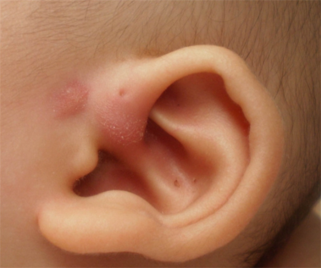 婴儿耳朵感染宝妈如何应对
