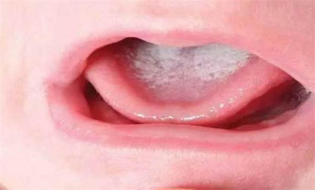婴儿口腔鹅口疮的原因是什么 如何治疗