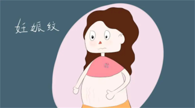 女性怀孕期间的妊娠纹4点需要注意
