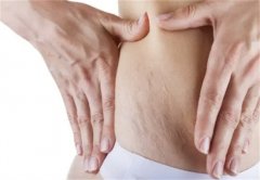 孕妇妊娠纹怎么去掉？改善饮食、使用乳液和按摩是关键