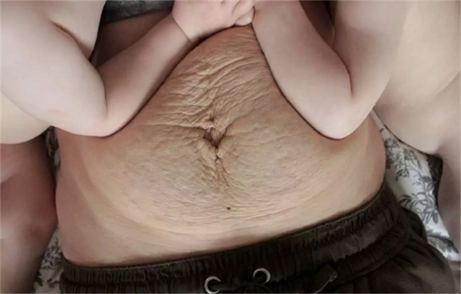 孕妇妊娠纹怎么去掉？改善饮食、使用乳液和按摩是关键