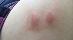红疙瘩痒痒的原因揭秘：探究身上起红疙瘩的成因
