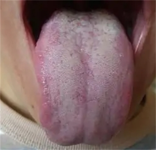 舌苔厚白：原因、治疗与日常调养