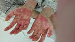 急性白血病：症状、原因和治疗方法