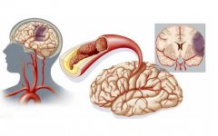 脑血栓治疗方案：及时干预降低危害