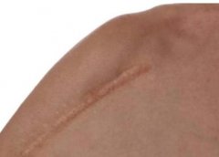 如何判断自身是否具有疤痕体质：观察皮肤与伤口反应