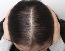 掉头发的原因及预防方法，遗传因素、缺乏蛋白质和马尾扎过紧