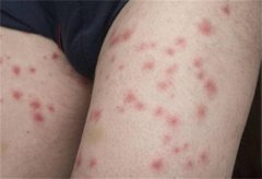 温暖季节外出，怎样有效应对虫咬过敏性皮炎？