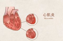 揭秘病毒性心肌炎：症状全解析，了解你的心脏健康