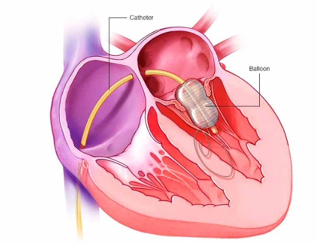 先天性心脏病：类型、症状及诊断