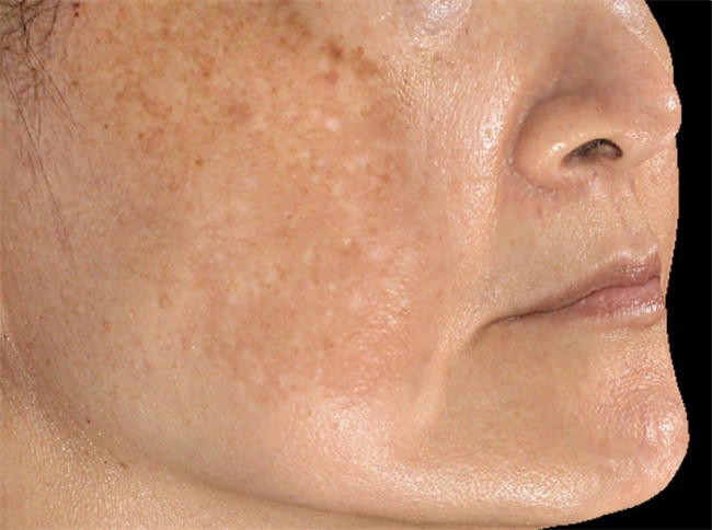 专业解读：脸部黑斑的成因与治疗方法