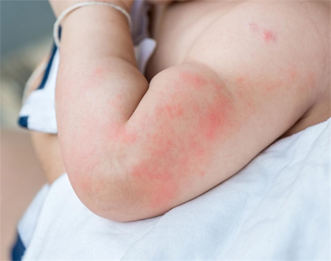 孩子患上荨麻疹？专业指导助您应对与护理