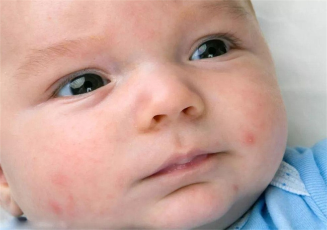 胎毒：新生儿皮肤症状背后的过敏真相与预防方法