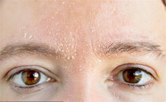  皮肤干燥起皮与瘙痒？专业护肤策略揭秘！