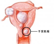 深入探讨子宫肌瘤：女性健康的不可忽视之敌