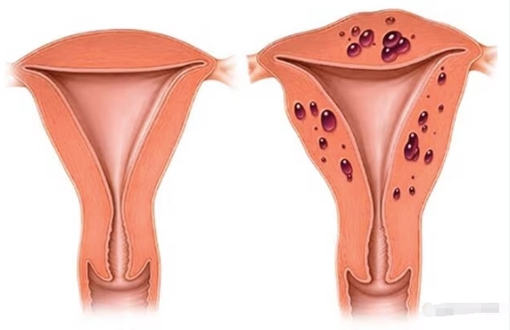 子宫腺肌症：科学探析与治疗策略解读