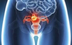 深度解析卵巢囊肿的成因与治疗策略
