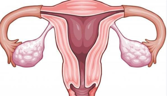 子宫直肠窝积液：女性健康的重要关切