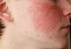 解密面部过敏性皮炎：原因、症状与防治方法