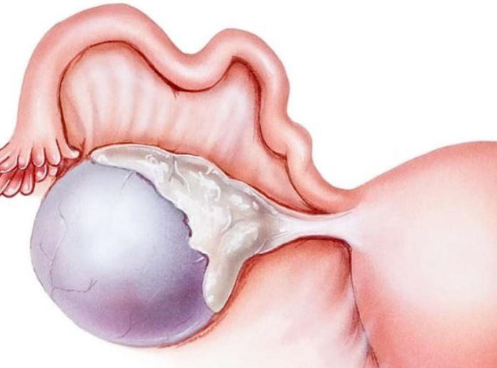 卵巢囊肿：常见但通常不严重的妇科疾病