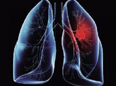 肺结核：早期症状与预防治疗