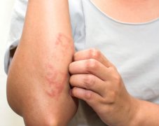 幼儿湿疹症状解析：红斑、水疱、抓挠等关键特征