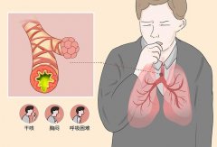 变异性哮喘症状及原因详解：呼吸困难、咳嗽、精神压力