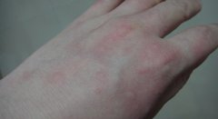 皮疹的治疗策略与注意事项