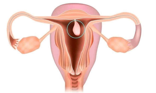 宝贵的子宫：了解子宫炎症对女性健康和生育的影响