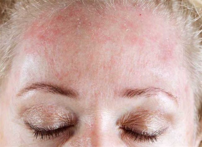 冬季护肤秘籍：如何有效应对身上干燥和瘙痒问题？