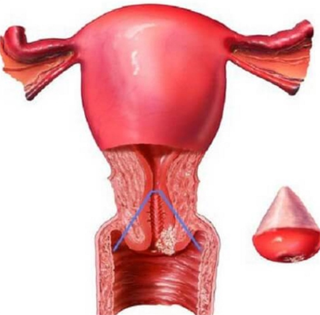 宫颈糜烂：女性健康的关键问题和治疗选择